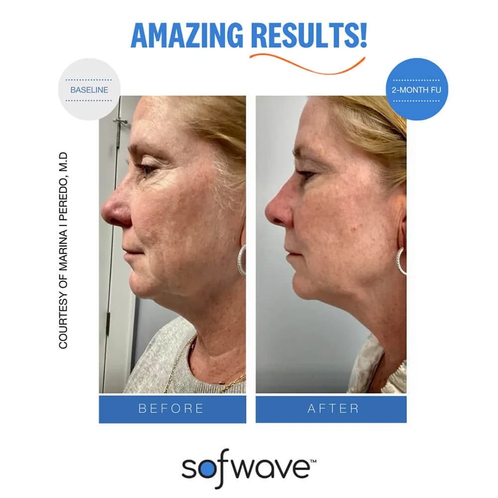 Sofwave Consultation
